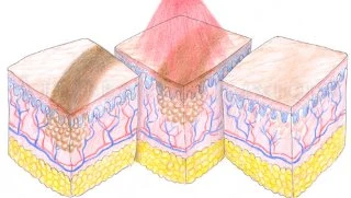 Permanent Make-up - Entfernung in Berlin